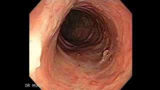 Colonoscopy of Ulcerative Colitis [upl. by Annanhoj]