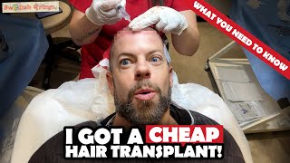 Had a Cheap Hair Transplant in Turkey – This Happened  SURGERY amp FIRST 6 WEEKS [upl. by Tisman]