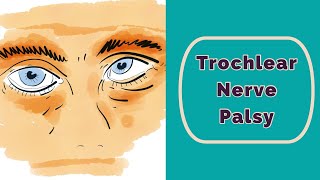 Trochlear Nerve Palsy Rapid Review [upl. by Razec]