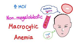 Nonmegaloblastic Macrocytic Anemia [upl. by Alexine]