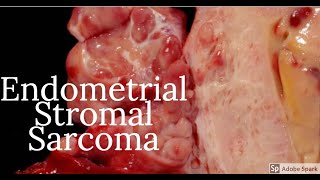 Digital Surgical Pathology 38 Endometrial Stromal Sarcoma [upl. by Sefton]