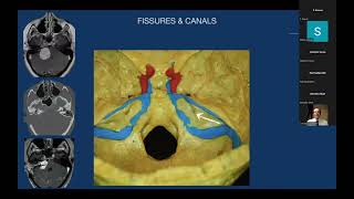 Anatomy and Surgical Approaches to Petrous Bone  Professor Pablo Gonzalez [upl. by Deland]