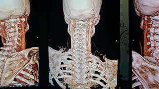 Head Extension Subluxates Atlas [upl. by Aras]