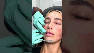 Lip Filler Technique using Hyaluronic Acid Filler fillersinjection lipsfiller filler [upl. by Shank]