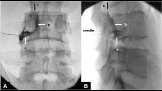 Fluoroscopic guided Lumbar epidural injection  Right L4 nerve root [upl. by Jacquelyn]