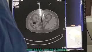 Vertebral Spine Biopsy [upl. by Feodora]