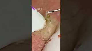 Pickel Ausdrücken Blackheads Mitesser Entfernung 🔴 62 [upl. by Atenek189]