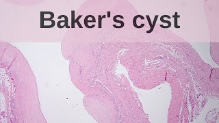 What is a Bakers Cyst  Pathology mini tutorials [upl. by Airret]