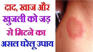 दाद खाज और खुजली को जड़ से मिटने का असल घरेलू उपाय  Treatment For Ringworm at Home [upl. by Constantina495]