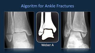 Algoritm for Ankle Fractures [upl. by Jessamyn418]