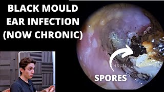 Black Mould Infection Is Now Chronic Otomycosis [upl. by Nirrek274]