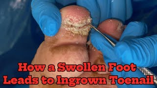 🚨Oedema amp Ingrown Toenails  Trust Your Podiatrist [upl. by Adnarahs]