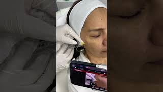 Tratamiento facial con Ozonoterapia formamosexecelencia [upl. by Bevan]