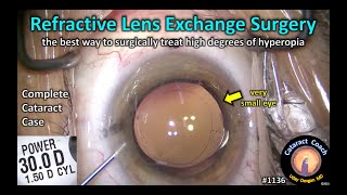 CataractCoach 1136 refractive lens exchange RLE surgery for high hyperopia [upl. by Niram680]