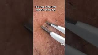 Satisfying Beard Ingrown Hair Removal [upl. by Annayehc]