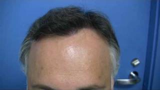 Hair Transplant by Dr Hasson  5732 Grafts  1 Session [upl. by Aehtrod]