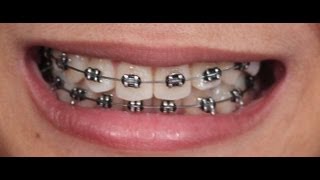 My Orthodontic Braces March 2013 [upl. by Olrak]