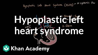 Hypoplastic left heart syndrome and norwood glenn fontan  NCLEXRN  Khan Academy [upl. by Norraa]