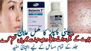 Best Acne Lotion  Dalacin T Lotion  Calindamycin 1 Acne Lotion Review In Urdu Hindi [upl. by Barrett]