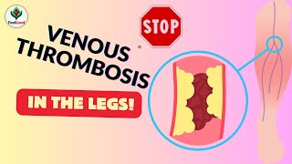 Warning Signs Deep Vein Thrombosis [upl. by Weihs]