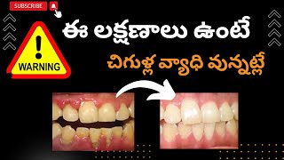 Gum problems in Telugu చిగుళ్ల సమస్య [upl. by Samantha]