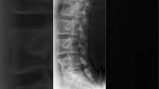 Lumbar Spine Oblique Radiology Tutorial [upl. by Suzann]