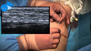 Positioning of endovenous catheter at the SaphenoFemoral Junction varicose veins [upl. by Isherwood807]