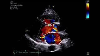 Video 1 Transthoracic echo showing parasternal long axis view with color doppler [upl. by So]