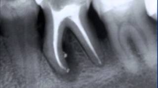 Aspecto radiografico de las lesiones del periodonto [upl. by Asante]