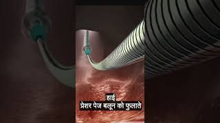 चलिए देखते हैं हार्ट की एंजियोप्लास्टी कैसे होते हैं3D Animation of Angioplasty Procedure [upl. by Samala515]