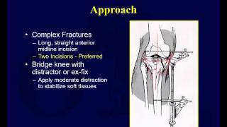 Tibial plateau fractures 1 [upl. by Hafler]