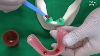 Dental Implant education video overdenture part [upl. by Ronalda]