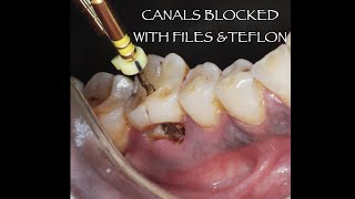 Endodontic management of CLASS V caries in 46 with caries perforating the floor of the pulp chamber [upl. by Im]