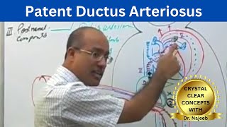 Patent Ductus Arteriosus  PDA [upl. by Fording]