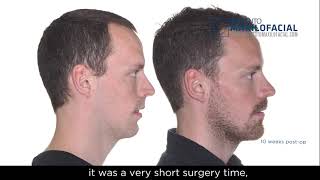 Jaw surgery Case  104 Johan  Sleep apnea maxillomandibular retrusion [upl. by Nimzaj]