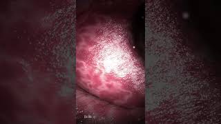 Colon Polypectomy Polyp Removal [upl. by Mufi321]