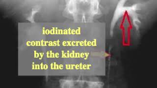 iodinated contrast used for intravenous pyelography IVP [upl. by Dolli]