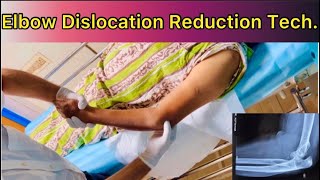 Elbow Dislocation Reduction How to Reduce Posterior Dislocation Elbow with patient in Supine positn [upl. by Anaer]