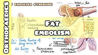 Fat Embolism Syndrome simplified for USMLE NCLEX NEET PG INICET NORCET [upl. by Mcfarland278]