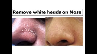 Turmeric to remove White heads on Nose Starnaturalbeauties [upl. by Fancie]