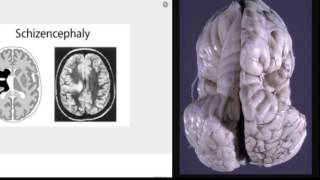 Schizencephaly presentation [upl. by Berga553]