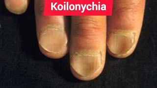 Leukonychia Platynychia and Koilonychia in Chronic iron deficiency anemia [upl. by Elfrida]