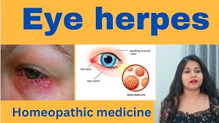 Eye herpes treatment  Eye herpes symptoms causes amp homeopathic medicine in hindi [upl. by Enirroc]