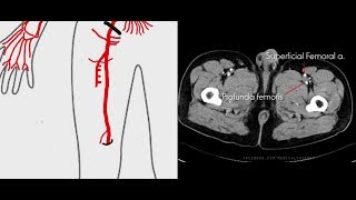 Arteries of Lower Limb  CT anatomy [upl. by Benn607]