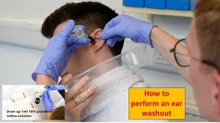 How to Perform an Ear Washout irrigation  ENTOtolaryngology Skills [upl. by Adabelle]