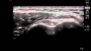 How To Biceps Tendon Ultrasound Exam Scanning Technique [upl. by Nightingale]