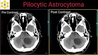 Pilocytic Astrocytoma [upl. by Blockus]