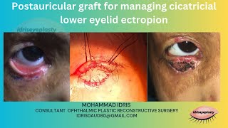 Postauricular skin graft for managing cicatricial lower eyelid ectropion [upl. by Eibbil]