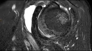 Subcoracoid bursitis [upl. by Enedan208]