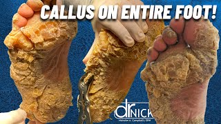 SHAVING CALLUS ON ENTIRE SOLE OF FOOT Dr Nick Campitelli Foot amp Ankle Surgeon [upl. by Elsa]